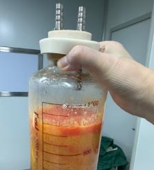 涿州水动力吸脂手术要做多久？